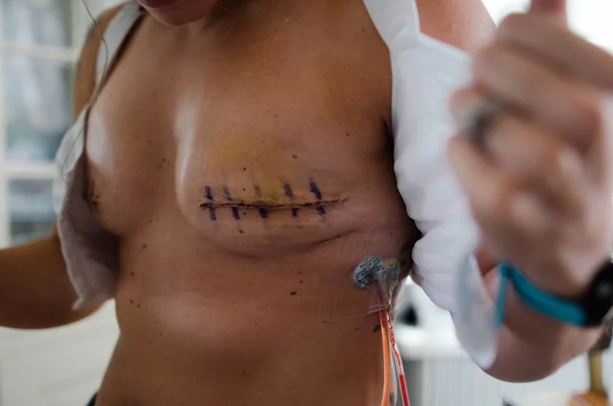Breast cancer 0